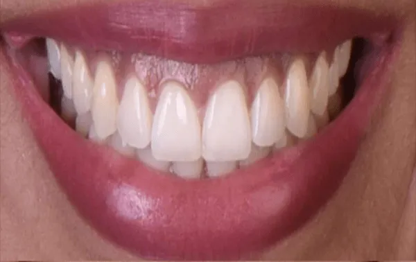 After use of Aligners