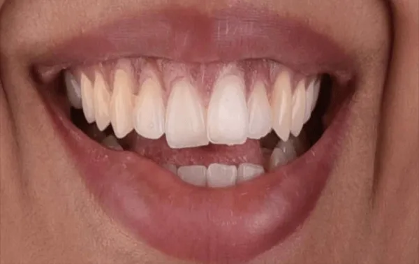 Before use of Aligners
