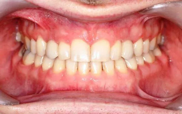 Clear braces after