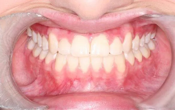 After use of Clear braces