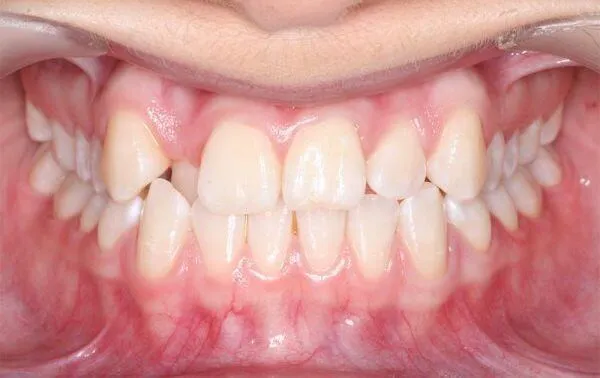 Before use of Clear braces