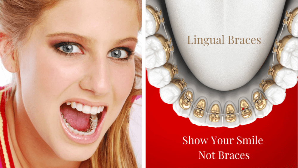 5 Main Differences between Invisalign and Lingual Braces