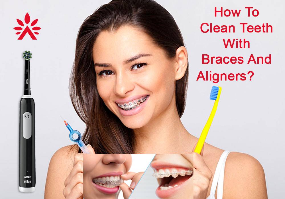 How to clean teeth with braces and Aligners?