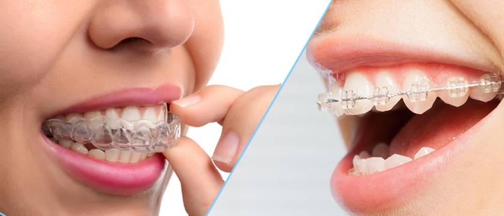 Orthodontics (Metal Braces / Invisalign) – Dental World Manila