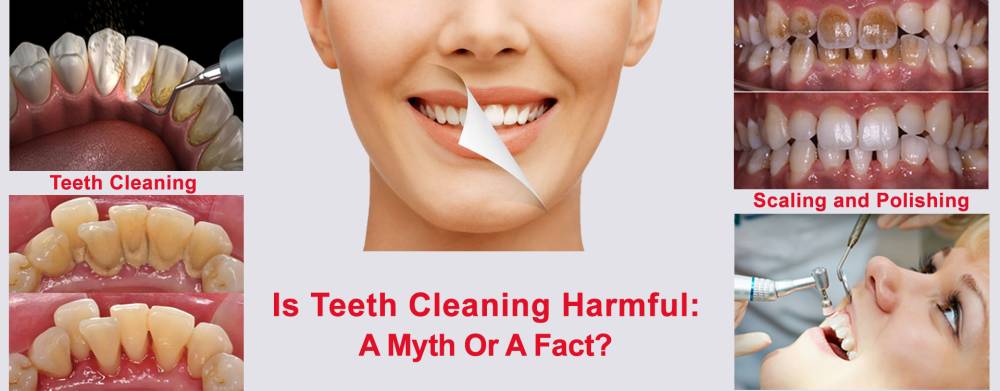 Teeth scaling is harmful: Dental myth or facts about teeth Cleaning