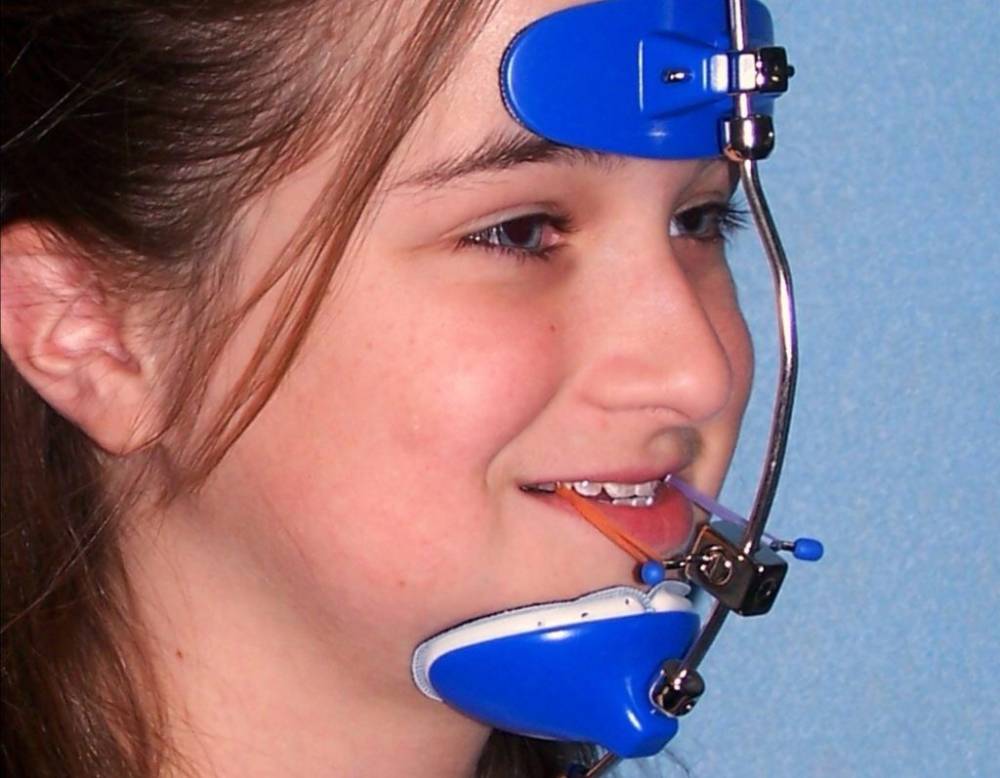 Orthodontic Headgear | Functional appliance |Palatal expansion