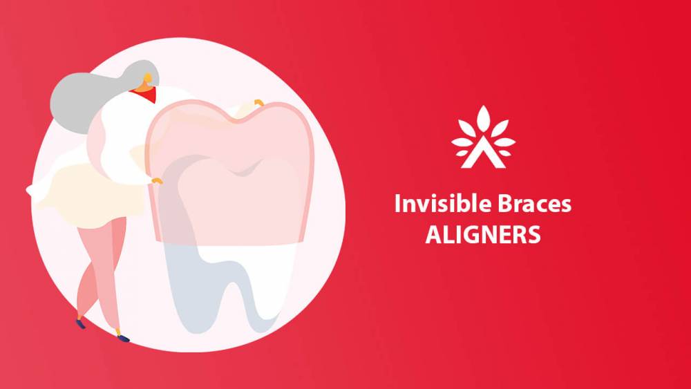 Ten Advantages of Aligners Over Other Types of Braces