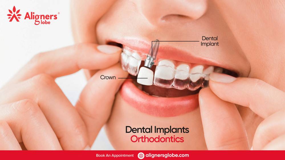 Dental Implant Orthodontics